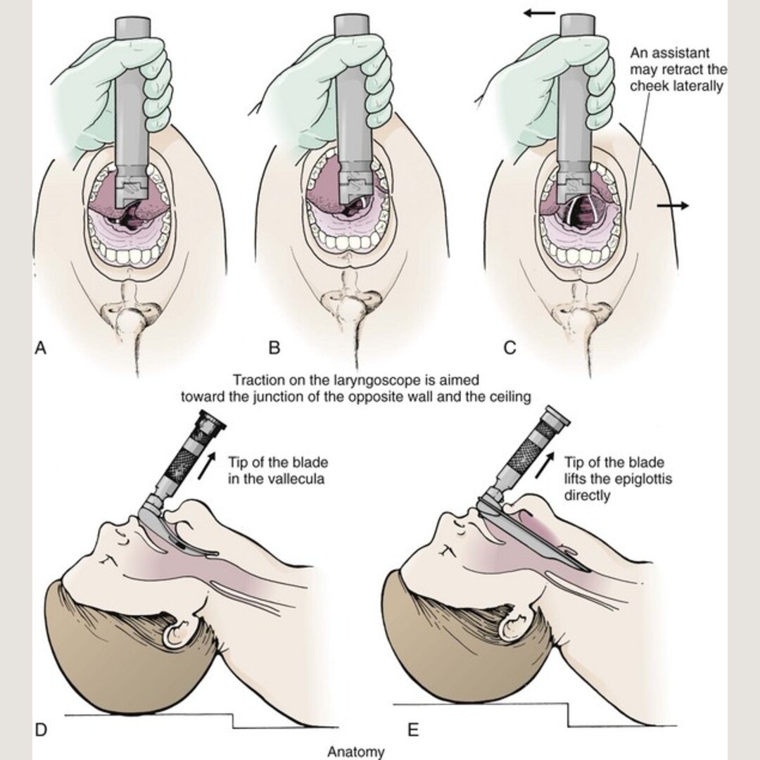 Steps to tracheal intubation (it hurts , don't go outside)