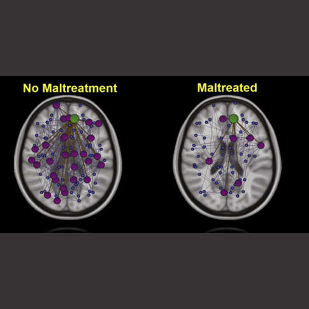 Differences in cerebral structure between maltreatment or non altreatment in childhood.