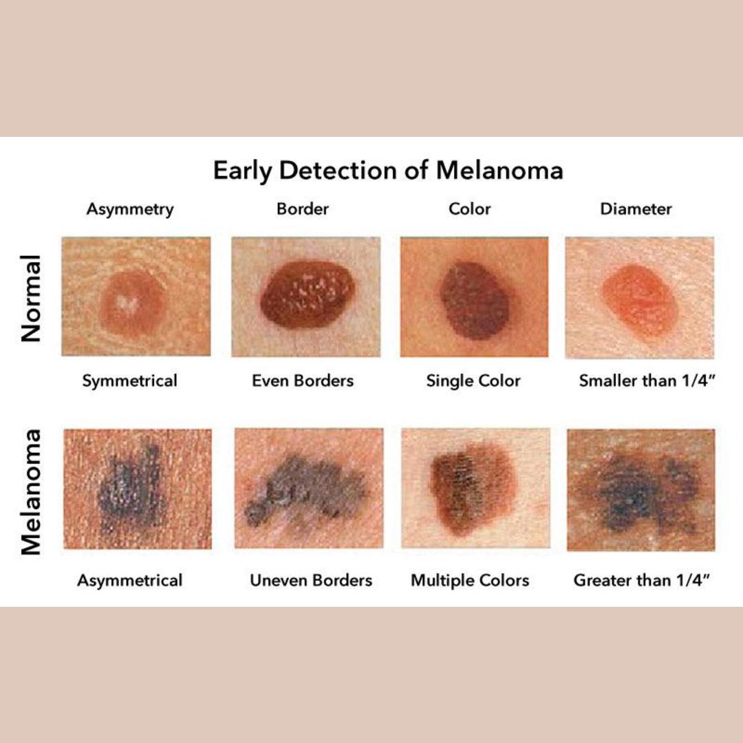 Remember to check regularly for melanoma—even on areas of your body not regularly exposed to the sun—and always remember ABCD (asymmetry, border, color, diameter.)